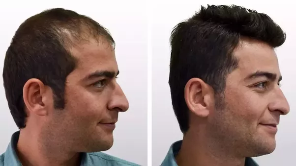 Hair Replacement