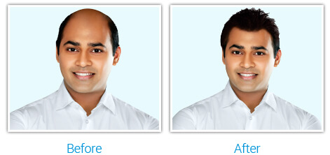Hair Replacement